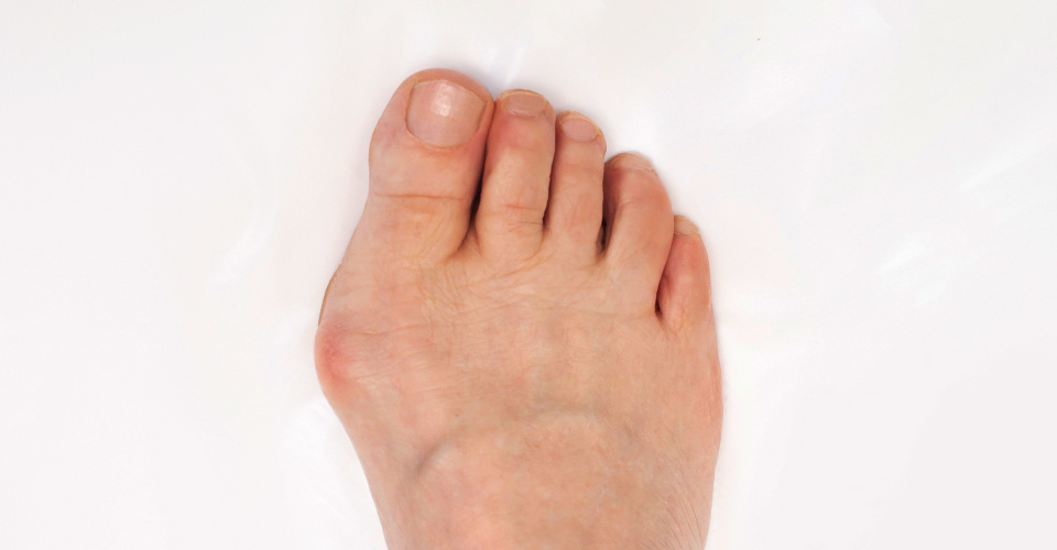 HALLUX VALGUS A INÉ DEFORMITY CHODIDLA